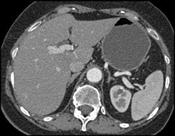 1 Cm Calcified Cyst in Upper Pole of the Left Kidney - CTisus CT Scan