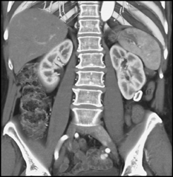 Calcified Node Near Lower Pole of the Left Kidney - CTisus CT Scan