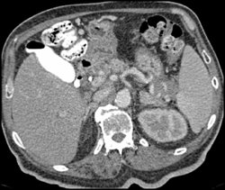 Acute Renal Vein Thrombosis in Left - CTisus CT Scan