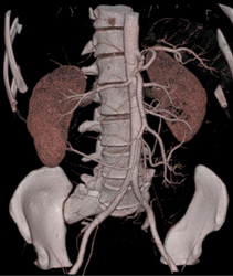 Multiple Renal Arteries - CTisus CT Scan