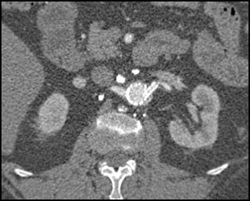 Stent in Renal Artery - CTisus CT Scan