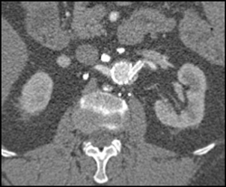 Patent Stent - CTisus CT Scan