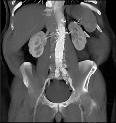 Renal Cell Carcinoma in Lower Pole of the Right Kidney - CTisus CT Scan