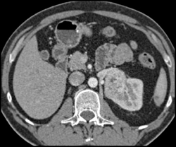 Renal Cell Carcinoma - CTisus CT Scan