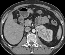 Renal Cell Carcinom - CTisus CT Scan