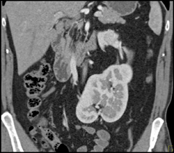 Renal Cell Carcinoma in A Horseshoe Kidney - CTisus CT Scan