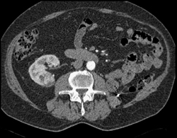 Renal Cell Metastatic to the Tail of the Pancreas With Vascular Metastases - CTisus CT Scan