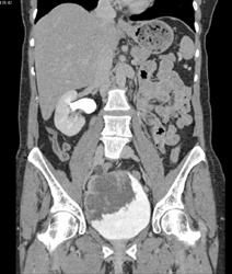 Bladder Cancer - CTisus CT Scan