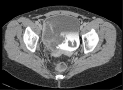 Bladder Cancer - CTisus CT Scan