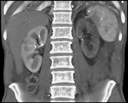 Decreased Left Renal Function Due to Renal Artery Stenosis - CTisus CT Scan