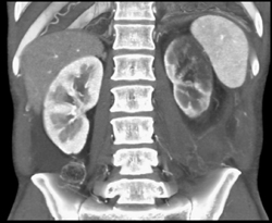 Renal Infarction - CTisus CT Scan