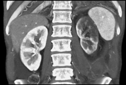 Renal Infarction - CTisus CT Scan