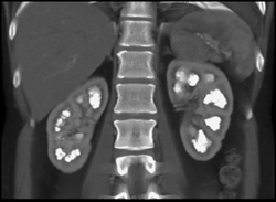 Renal Medullary Calcinosis - CTisus CT Scan