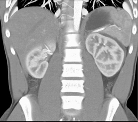 Resolving-perirenal Hematoma - CTisus CT Scan