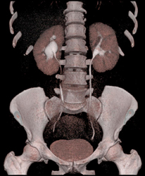 Mild Ureteropelvic Junction (UPJ) on the Right - CTisus CT Scan