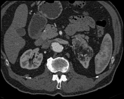 Renal Infarct - CTisus CT Scan