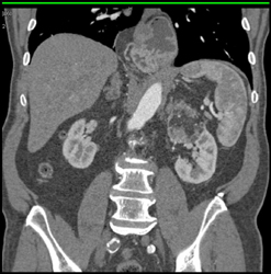 Renal Infarct - CTisus CT Scan