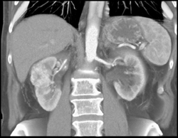 Renal Cell Carcinoma - CTisus CT Scan