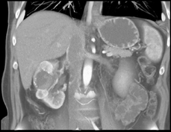 Renal Cell Carcinoma - CTisus CT Scan