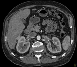 Renal Cell Carcinoma - CTisus CT Scan