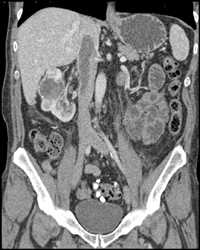 Renal Cell Carcinoma - CTisus CT Scan