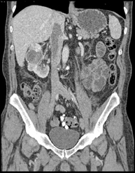 Renal Cell Carcinoma - CTisus CT Scan