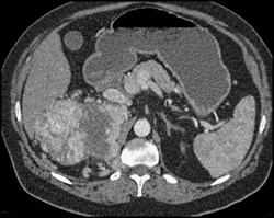 Renal Cell Carcinoma - CTisus CT Scan