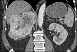 Vascular Renal Cell Carcinoma (RCC) With Vascular Nodes - CTisus CT Scan