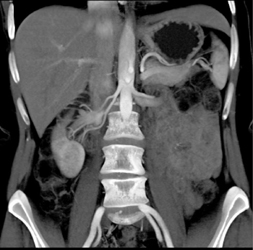 Angiomyolipoma (AML) - CTisus CT Scan