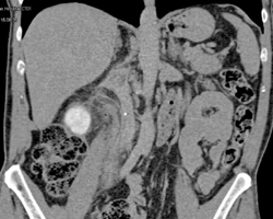 Stone in Proximal Ureter - CTisus CT Scan