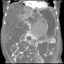 Pck - CTisus CT Scan