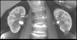 Stone in Renal Pelvis - CTisus CT Scan