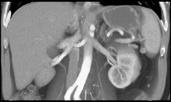 Av Fistulae in Renal Pelvis - CTisus CT Scan