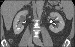 Late Phase Hides Av - CTisus CT Scan