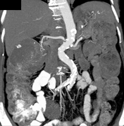 Renal Artery Stenosis - CTisus CT Scan