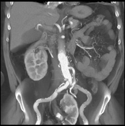 Pelvic Kidney With Stone - CTisus CT Scan