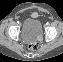 Bladder Cancer - CTisus CT Scan