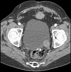 Tumor in Paravescle Space?? - CTisus CT Scan