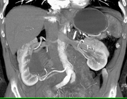 Ureteropelvic Junction (UPJ) Due to Crossing Vessel - CTisus CT Scan