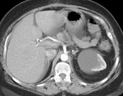 Renal Lymphoma - CTisus CT Scan