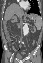 Occluded Ulcer Off Aorta - CTisus CT Scan