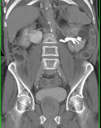 Prostate Cancer - CTisus CT Scan