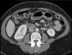 Renal Laceration - CTisus CT Scan