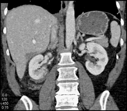 Renal Laceration - CTisus CT Scan