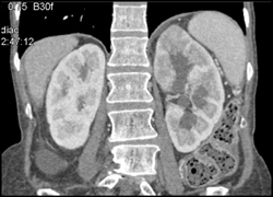 Acute Pyelonephritis - CTisus CT Scan