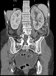 Acute Pyelonephritis - CTisus CT Scan