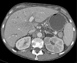 Acute Pyelonephritis - CTisus CT Scan