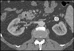 Incidental Renal Aneurysm - CTisus CT Scan