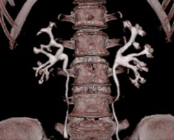 Normal CT Urogram - CTisus CT Scan