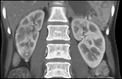Acute Pyelonephritis on the Right - CTisus CT Scan